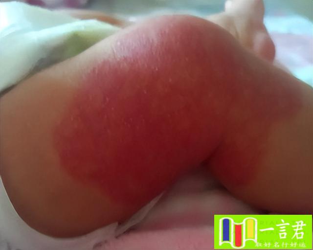 屁股上有胎记代表什么（孩子出生后身上出现的三种胎记，如何从颜色分辨是否需要去医院）